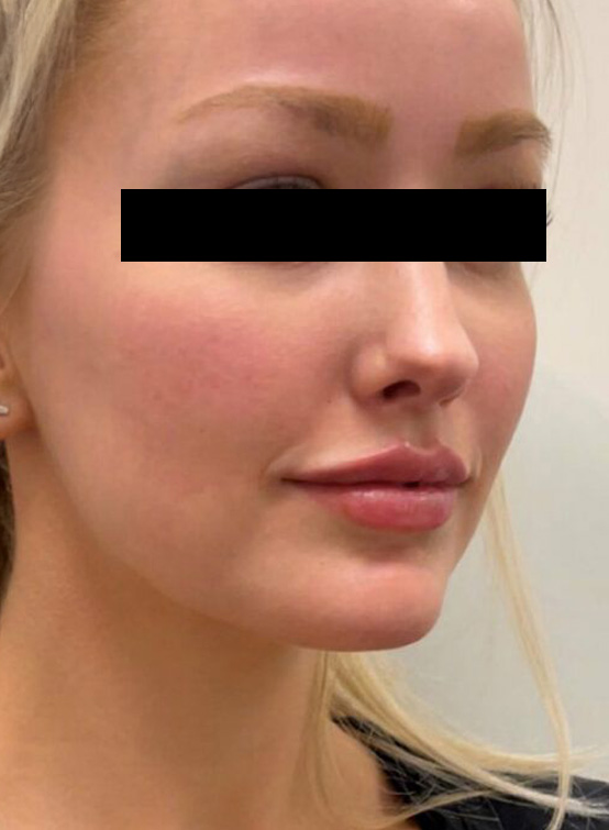 Visage avec soins esthétiques: Botox, PRP, acide hyaluronique. Clinique ELXYR Mont-Saint-Hilaire, consultation gratuite 20 min.