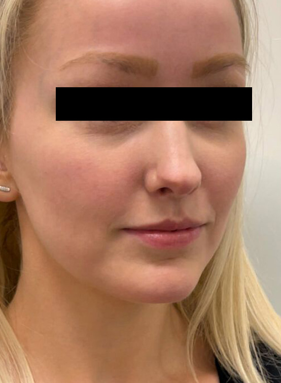 Visage avant fillers pour les lèvres à la Clinique Elxyr, Mont-Saint-Hilaire. 20 min de consultation gratuite.