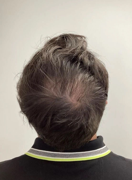 Densité des cheveux avant le traitement PRP à la Clinique Elxyr Mont-Saint-Hilaire. Consultation gratuite 20 min.