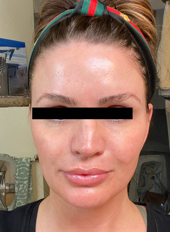 Après PRP visage complet