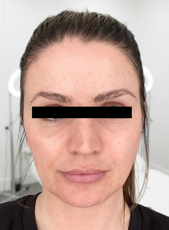 Avant PRP visage complet