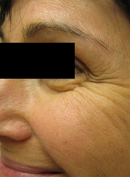 Pattes d'oie avanttraitement botox à la Clinique Elxyr, Mont-Saint-Hilaire. Consultation gratuite 20 min.